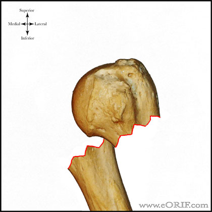 Type A3 proximal humerus fracture Type A3 proximal humerus fracture