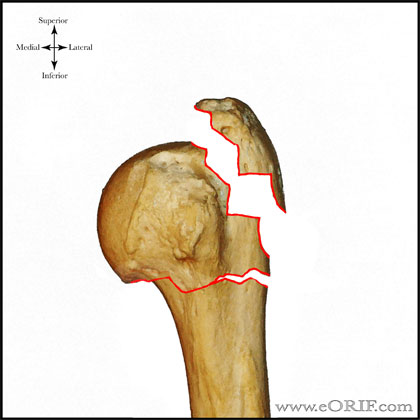Type B1 proximal humerus fracture Type B1 proximal humerus fracture