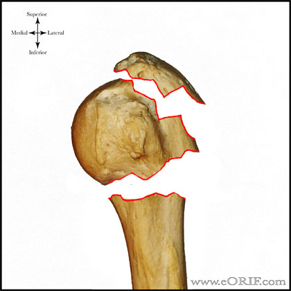 Type B2 proximal humerus fracture Type B2 proximal humerus fracture