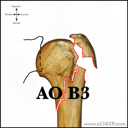 Type B3 proximal humerus fracture Type B3 proximal humerus fracture