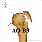 AO B3 proximal humerus fracture AO B3 proximal humerus fracture
