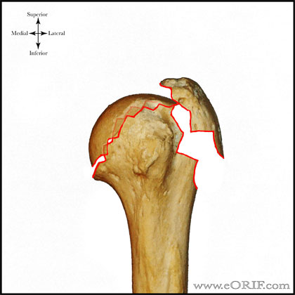 Type C1 proximal humerus fracture Type C1 proximal humerus fracture