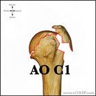 AO C1 proximal humerus fracture AO C1 proximal humerus fracture