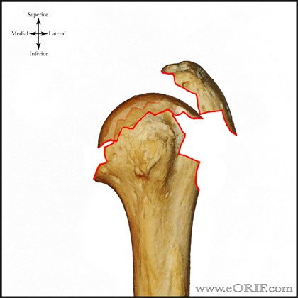 Type C2 proximal humerus fracture Type C2 proximal humerus fracture