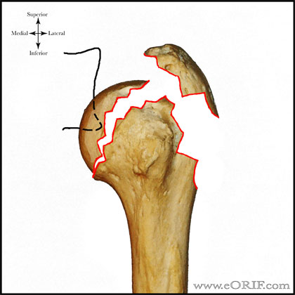 Type C3 proximal humerus fracture Type C3 proximal humerus fracture