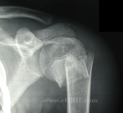 Pediatric proximal humerus fracture Pediatric proximal humerus fracture xray