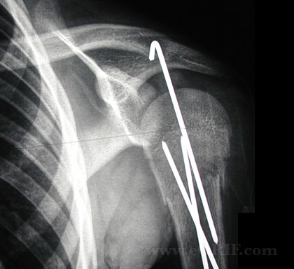 Pediatric proximal humerus fracture CRPP Pediatric proximal humerus fracture CRPP xray