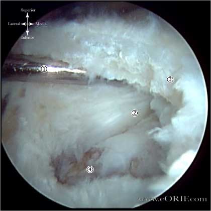 Rotator cuff tear rotator cuff tear arthroscopic view