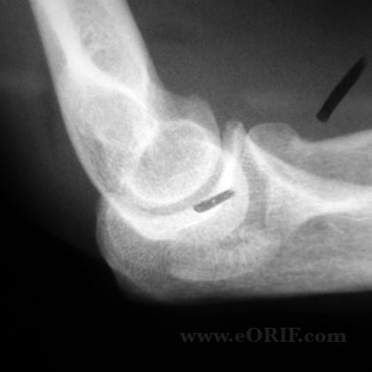 Radial Head Fracture ORIF 24665 Radial Head Fracture