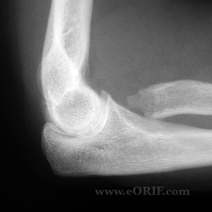 Radial Head Fracture ORIF 24665 Radial Head Fracture excision xray