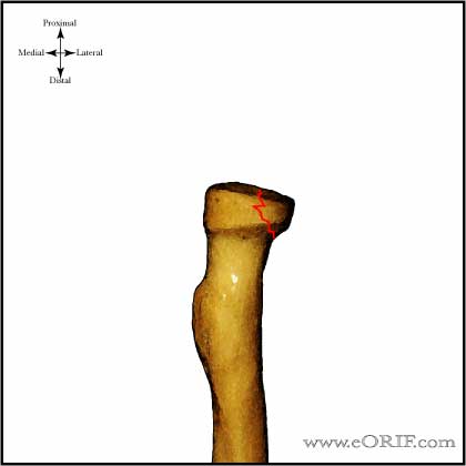 type I radial head fracture picture Type I radial head fracture image