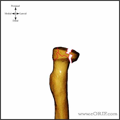 Type III Radial head fracture image Type III Radial head fracture