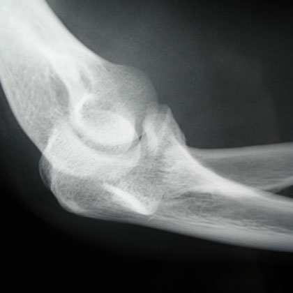 Radial Head fracture X-ray