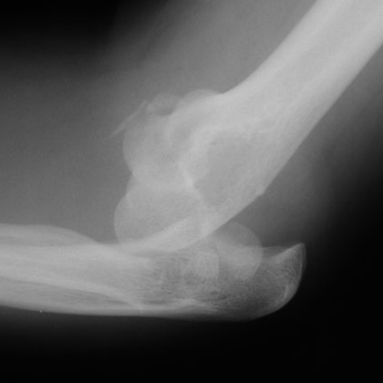 Mason Type IV radial head fracture xray