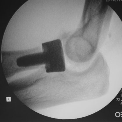 Radial Head Fracture Radial Head arthroplasty xray