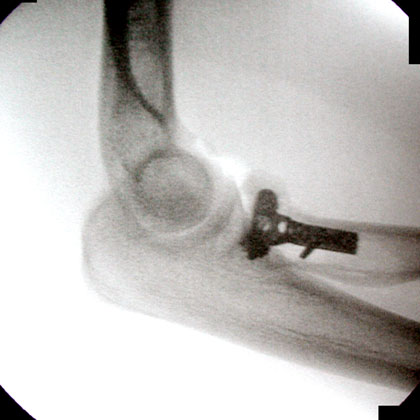 Radial Head Fracture ORIF xray