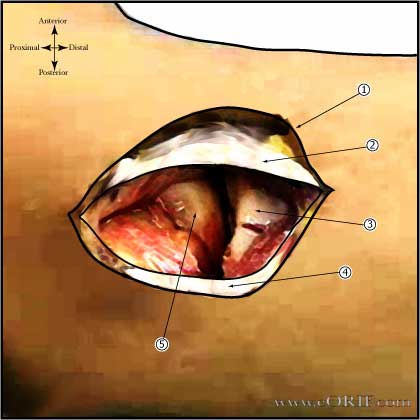 Radial Head Fracture ORIF 24665 Radial head surgical approach