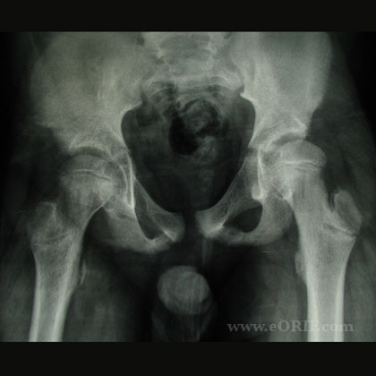 SCFE xray SCFE AP pelvis xray