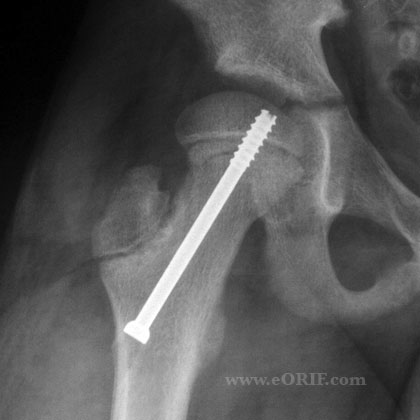 SCFE pinning xray SCFE Insitu pinning xray