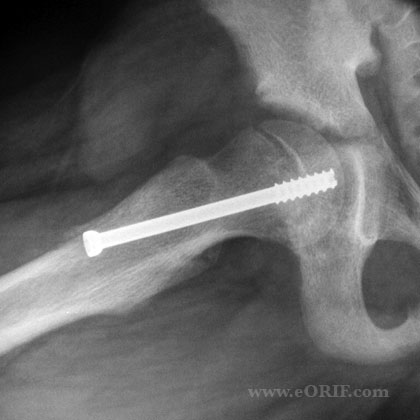 SCFE xray SCFE pinning xray