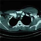 SC Dislocation CT Sternoclavicular Dislocation CT