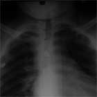 SC joint dislocation Sternoclavicular joint dislocation
