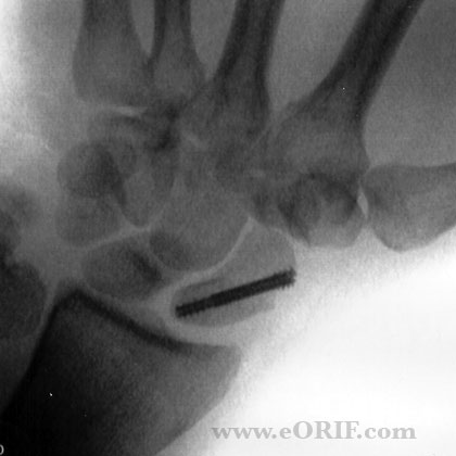 Scaphoid fracture xray Scaphoid fracture ORIF xray