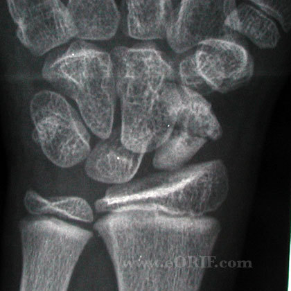 Pediatric scaphoid fracture Pediatric scaphoid fracture xray