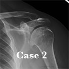 shoulder osteoarthritis xray shoulder osteoarthritis xray