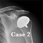 shoulder resurfacing hemiarthroplasty shoulder resurfacing hemiarthroplasty