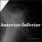 anterior shoulder dislocation anterior inferior shoulder dislocation