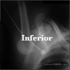 Luxatio Erecta inferior shoulder dislocation
