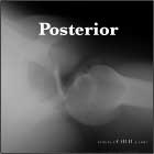Posterior shoulder dislocation Posterior shoulder dislocation