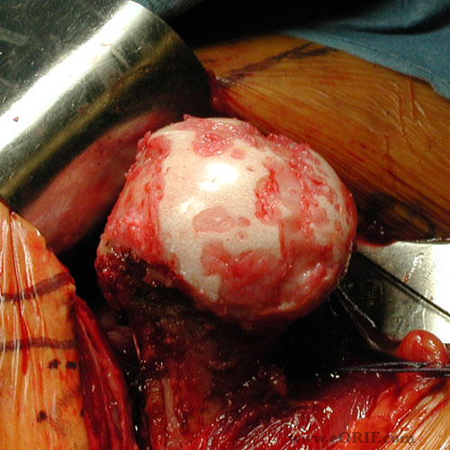 shoulder arthritis picture shoulder arthritis picture