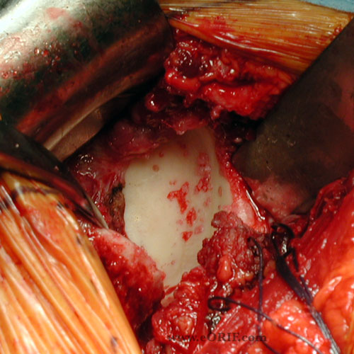 shoulder arthritis picture shoulder arthritis picture