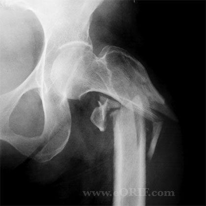 Subtrochanteric femur fracture Subtrochanteric femur fracture xray