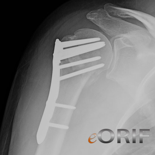 synthes proximal humerus plate xray synthes proximal humerus plate xray