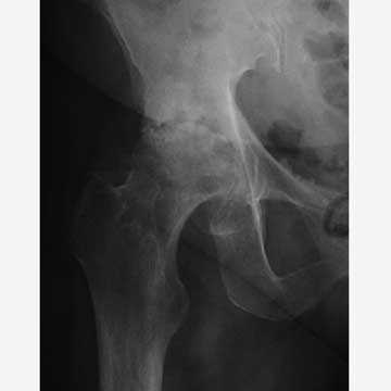 Hip AVN xray Hip Avascular necrosis xray