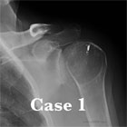 shoulder osteoarthritis xray shoulder osteoarthritis xray
