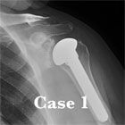 Total Shoulder Arthroplasty Total Shoulder Arthroplasty xray