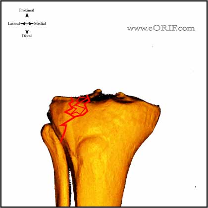 Type 2 Tibial Plateau Fracture image Type II Tibial Plateau Fracture image