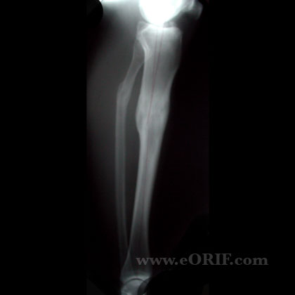 Tibial Shaft Fracture Malunion Tibial Shaft Fracture Malunion