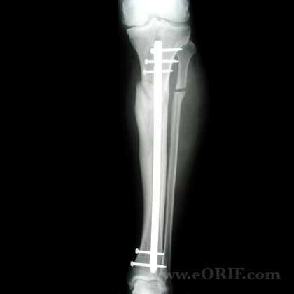 Tibial Shaft Fracture Malunion osteotomy Tibial Shaft Fracture Malunion IM nail