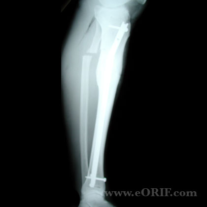 Tibial Shaft Fracture Malunion osteotomy Tibial Shaft Fracture Malunion IM nail