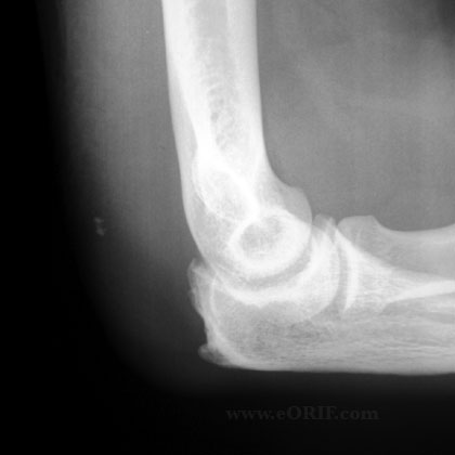 triceps tendon rupture xray triceps tendon rupture xray