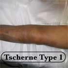 Tsherne Type I soft tissue injury image Tsherne Type I soft tissue injury image