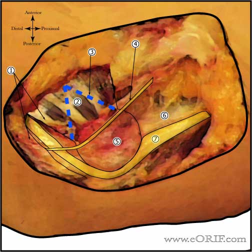 Cubital tunnel anatomy Ulnar Nerve Transposition anatomy