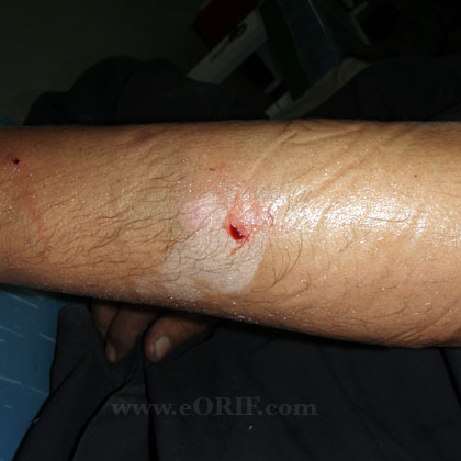 grade 1 open ulnar shaft fracture grade 1 open ulnar shaft fracture