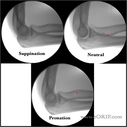 Lateral Elbow Xray Lateral Elbow Xray