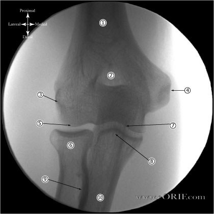 A/P Elbow Xray A/P Elbow Xray